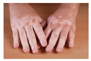 01/8 – Dia Nacional dos Portadores de Vitiligo